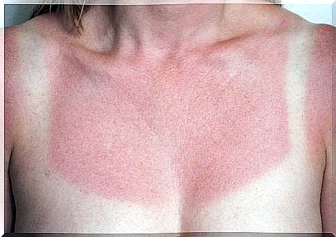 woman with sunburn 