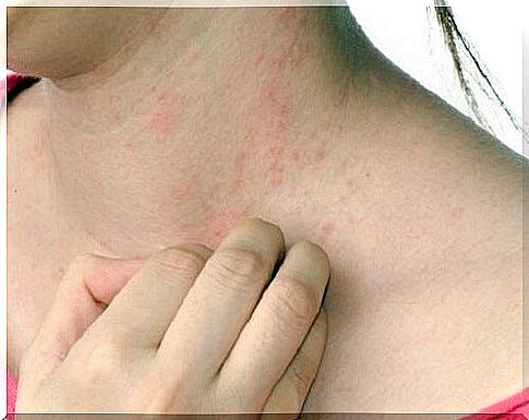 Symptoms of atopic dermatitis