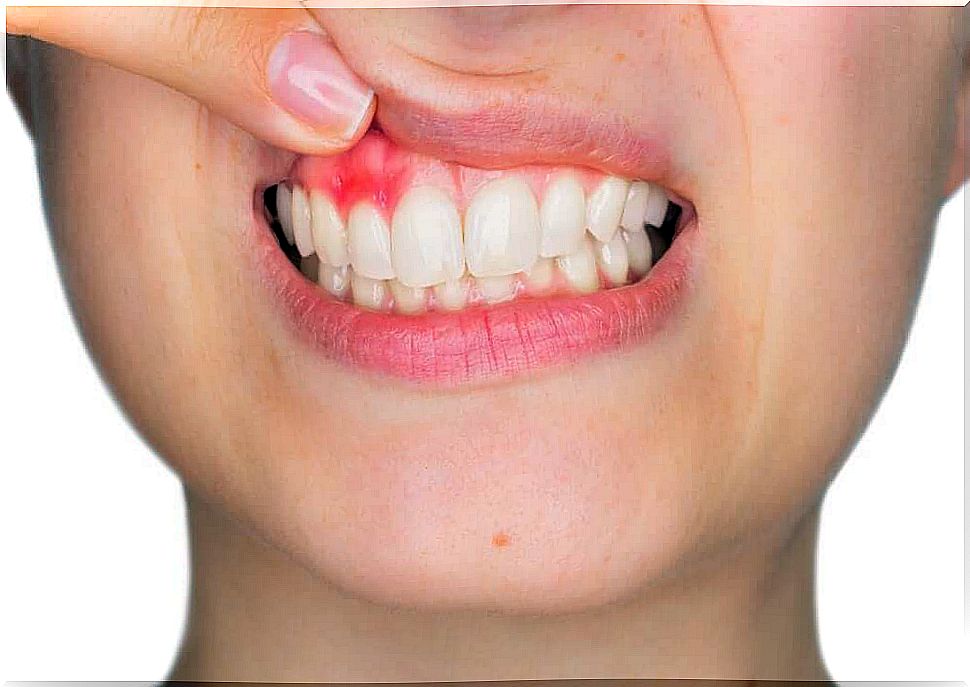 Inflamed gums