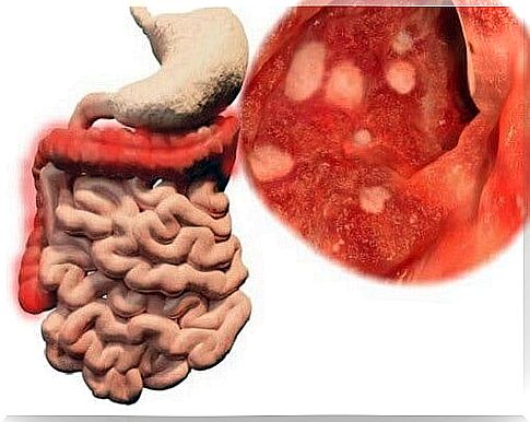 Bacterium present in the intestine caused by food poisoning.