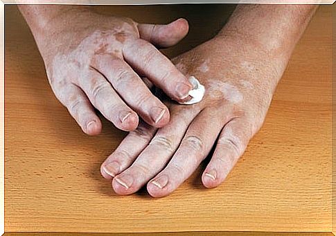 Causes of vitiligo: why it appears and how to eliminate it