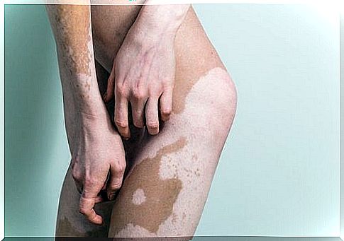 causes of vitiligo