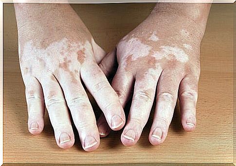 causes of vitiligo