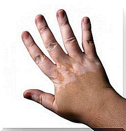 vitiligo 3