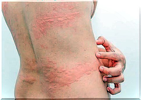 Woman with cold urticaria.