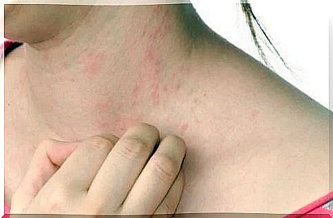 Woman with cold urticaria in the neck.