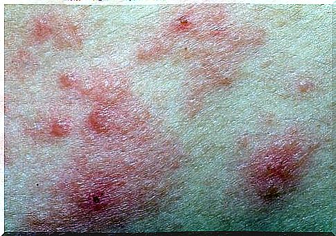 Dermatitis.