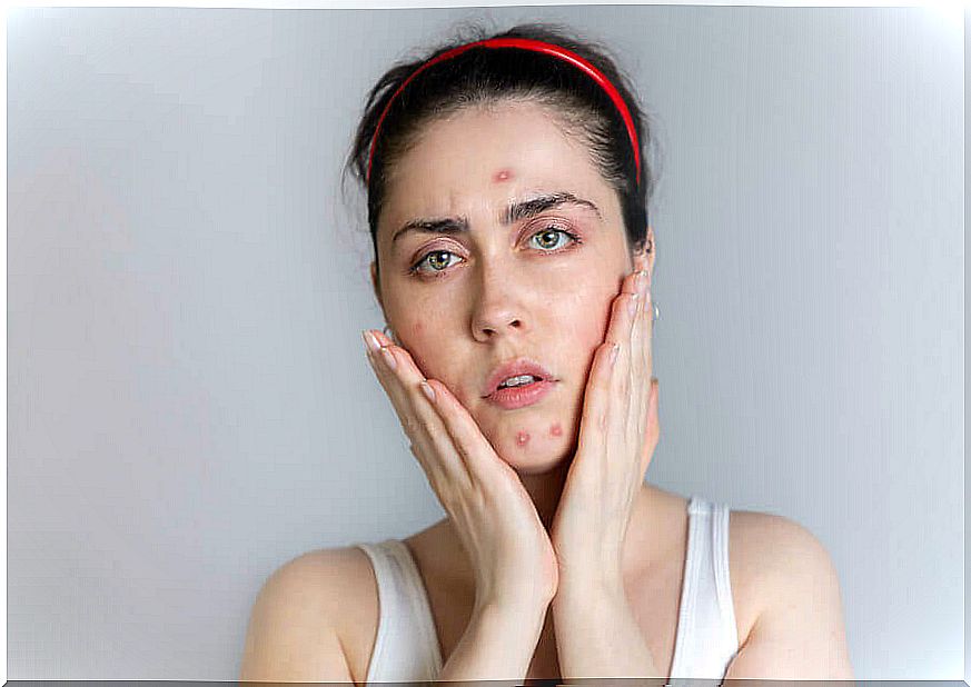 Woman with acne on her face.