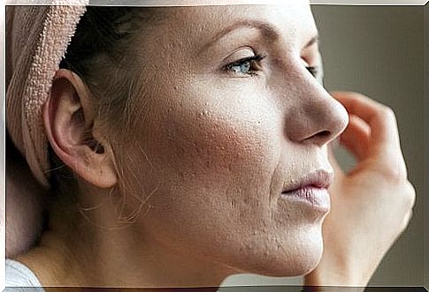 Woman with acne