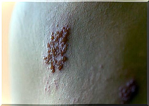 Shingles rash