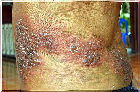 Shingles rash along the nerve