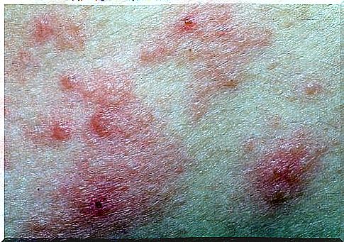 skin with dermatitis