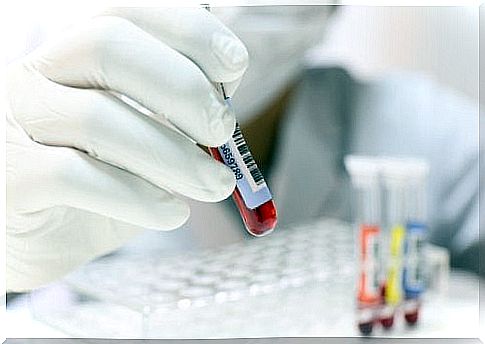 Hypocalcemia analysis