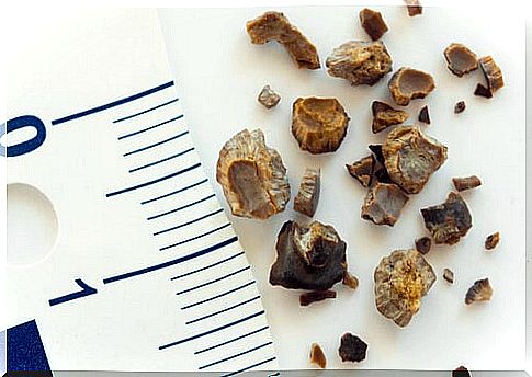 kidney stones