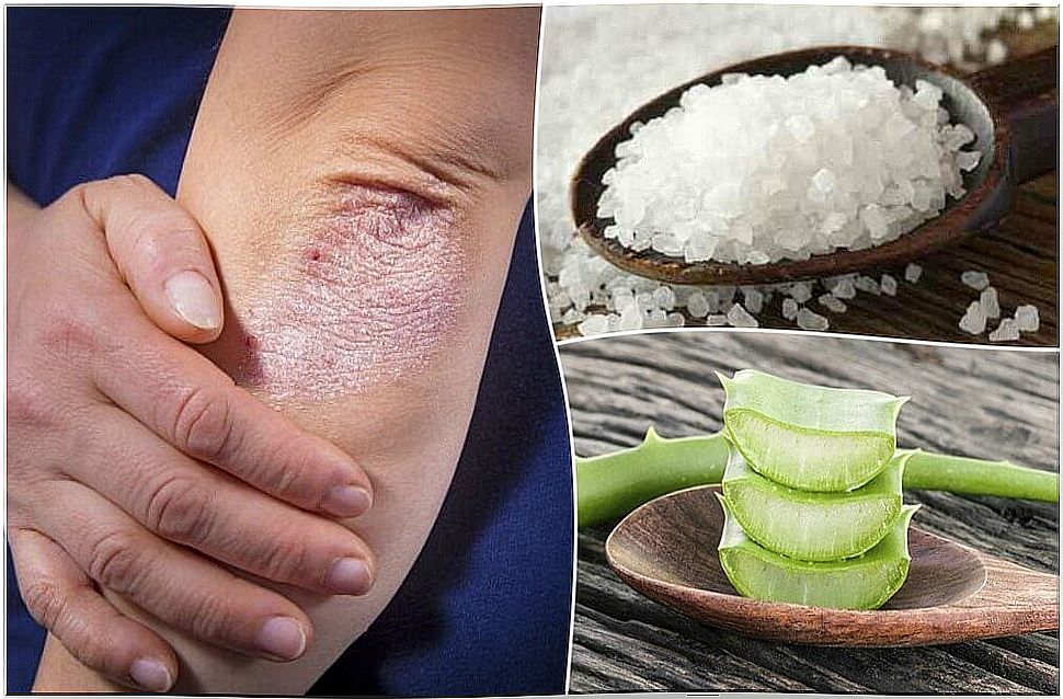 Skin mycosis: 5 natural solutions