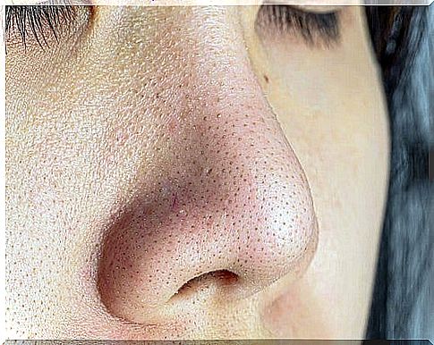 Blackheads