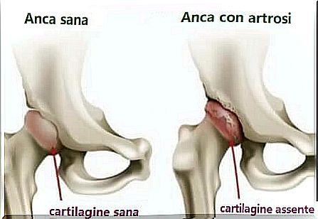 Healthy hip and hip with osteoarthritis