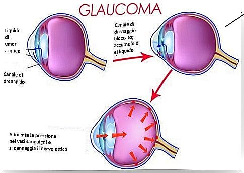 Description of glaucoma