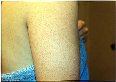 Pimples on the arms: how to get rid of them