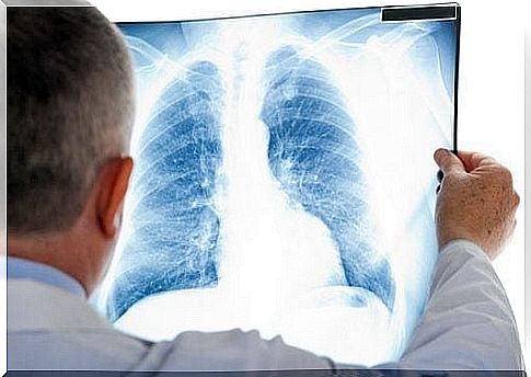 Pulmonary embolism: symptoms and treatment