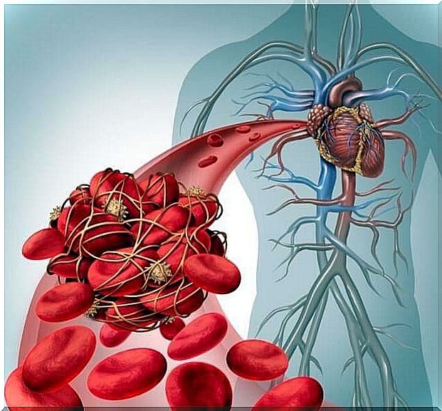 Thrombosis in the body.