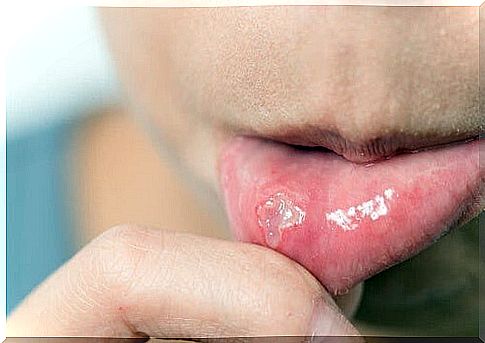 Quickly treat mouth ulcers with 5 remedies