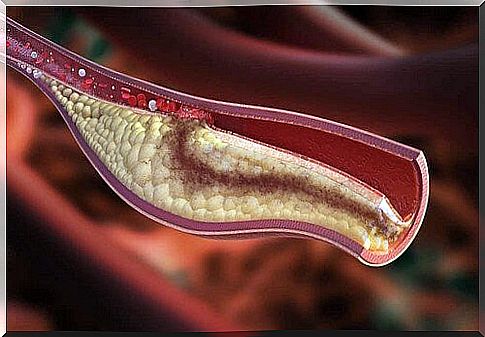 Cholesterol control.