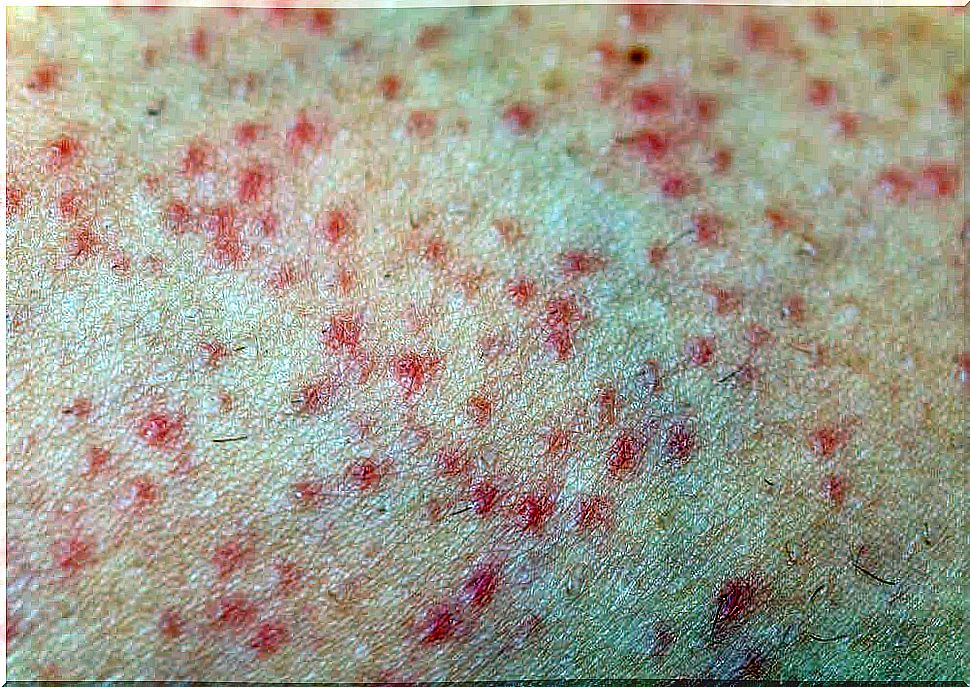 Skin with keratosis pilare  