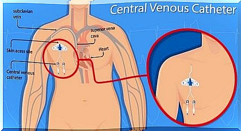 Vascular perforation from central venous catheter