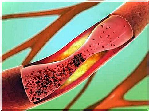 Cerebrovascular accident